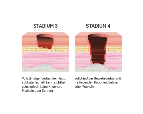 klassifikation wundstadium